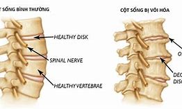 Vôi Cột Sống Là Gì